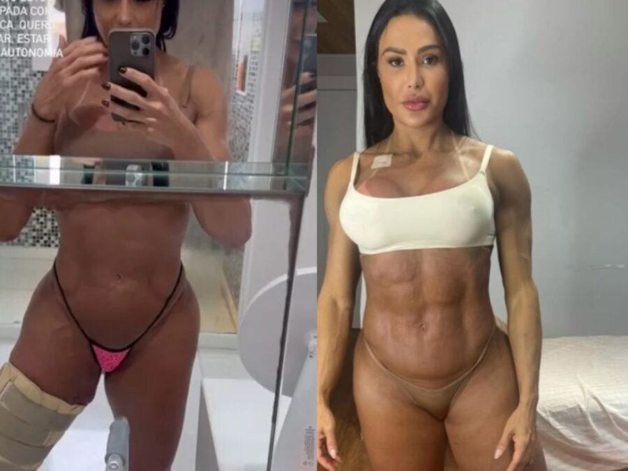 Gracyanne Barbosa fala sobre ganho de peso e exibe joelho 14 dias após cirurgia
