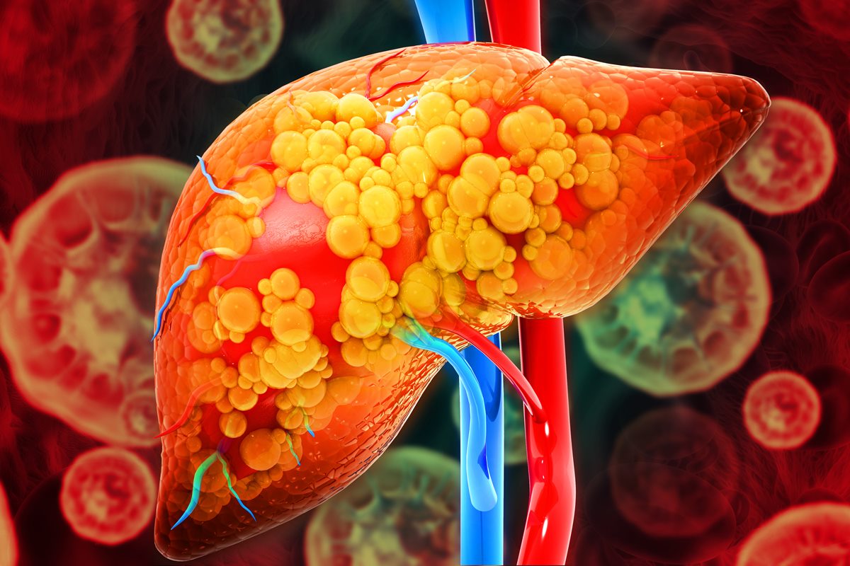 Como saber se estou com gordura no fígado? Hepatologista responde