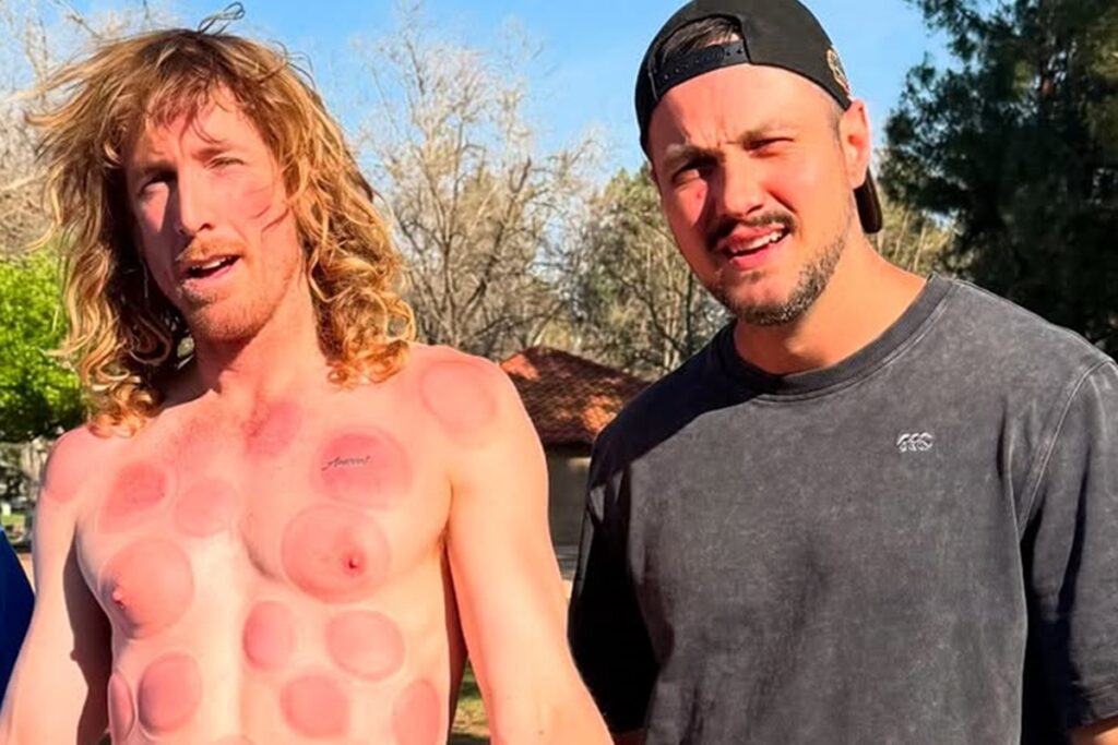 imagens-fortes:-youtuber-sofre-queimaduras-durante-show-com-chamas