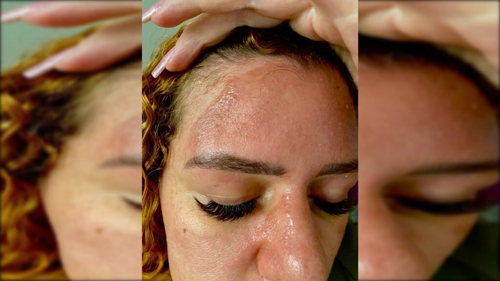 influenciadora-tem-serias-queimaduras-apos-panela-de-pressao-explodir