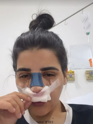 recem-solteira,-yasmin-santos-faz-rinoplastia-:-“recomendacoes-medicas”
