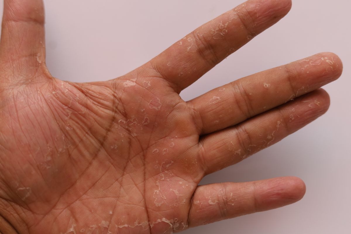 Entenda o que bolhas nos pés e nas mãos podem significar