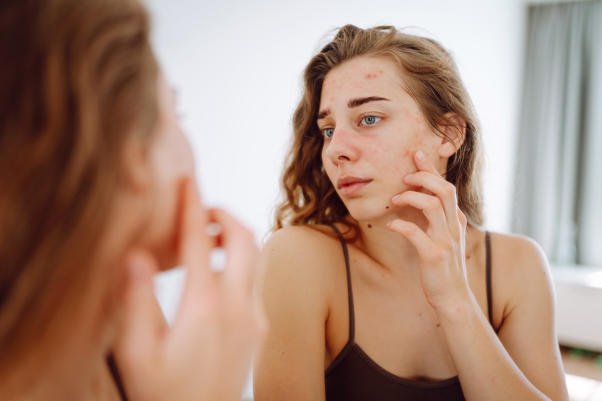 cicatrizes-de-acne:-veja-como-prevenir-e-dicas-para-cuidar