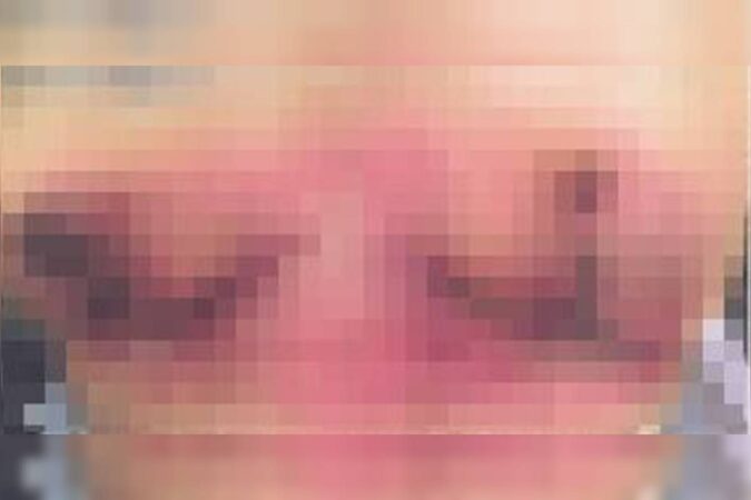 mulher-denuncia-medico-do-df-por-erro-apos-perder-os-seios-em-cirurgia