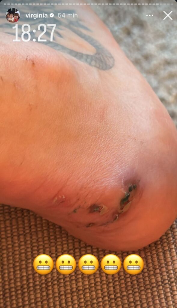 virginia-exibe-ferimentos-nos-pes-apos-ensaio-na-grande-rio-e-brinca:-“esta-tranquilo!”