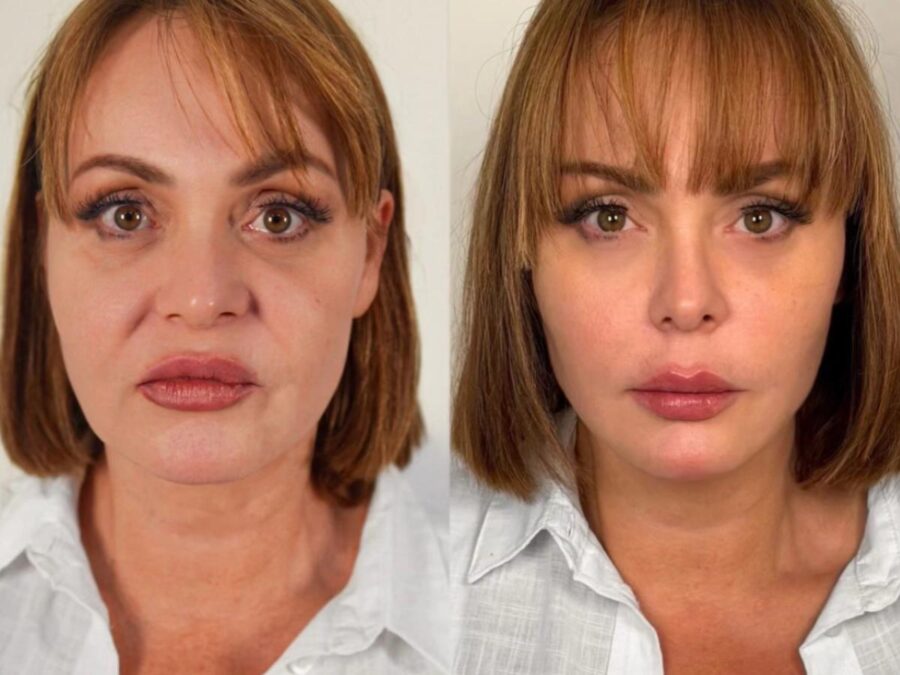 Após “A Fazenda”, Gaby Spanic faz harmonização e resgata feição da “Usurpadora”