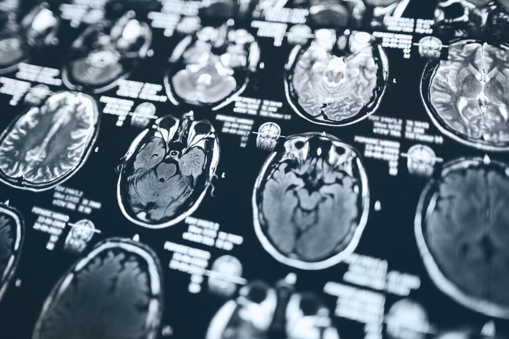 AVC: cardiologistas explicam como a dieta atua na prevenção do derrame