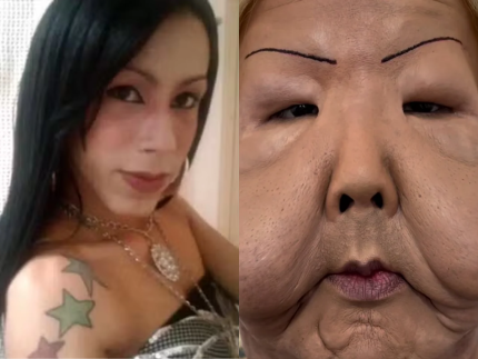 influenciadora-juju-do-pix-realiza-cirurgia-para-retirada-de-oleo-mineral-do-rosto