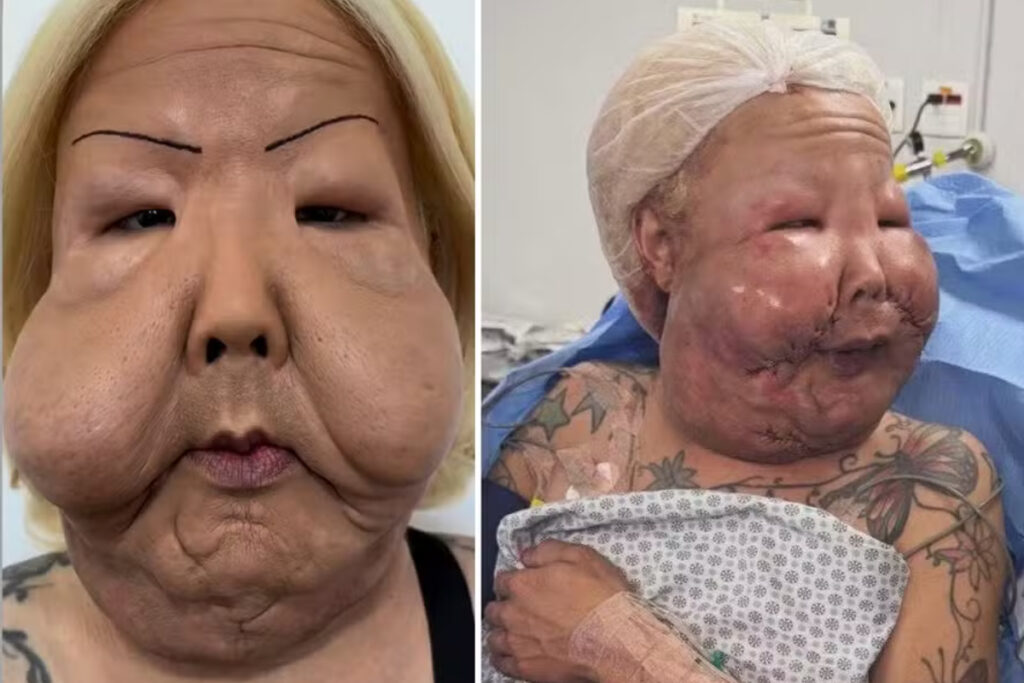 medico-mostra-oleo-mineral-retirado-do-rosto-de-juju-do-pix;-veja-foto