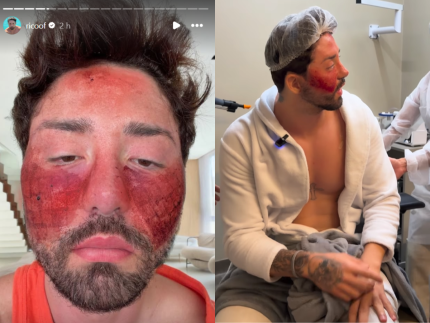 rico-melquiades-revela-detalhes-de-tratamento-para-cicatrizes-de-acne:-“bem-dolorido”