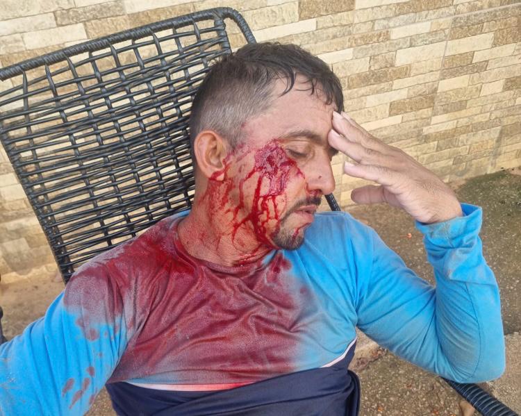 O trabalhador sofreu um trauma de face, e precisará passar por procedimentos cirúrgicos.