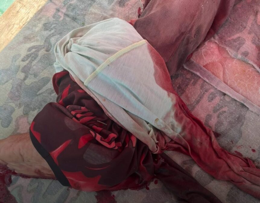 Homem sofre grave ferimento no pé após acidente com roçadeira na comunidade São Salvador