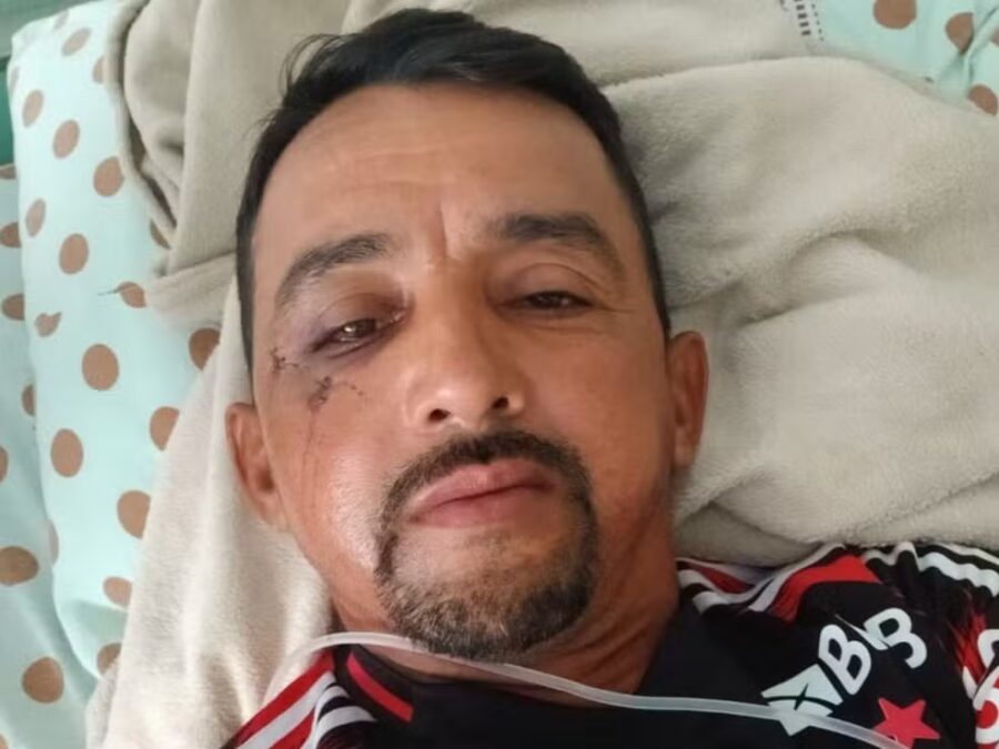 Gari agredido com tijolo no rosto passará por cirurgia após ataque de morador em Rio Branco