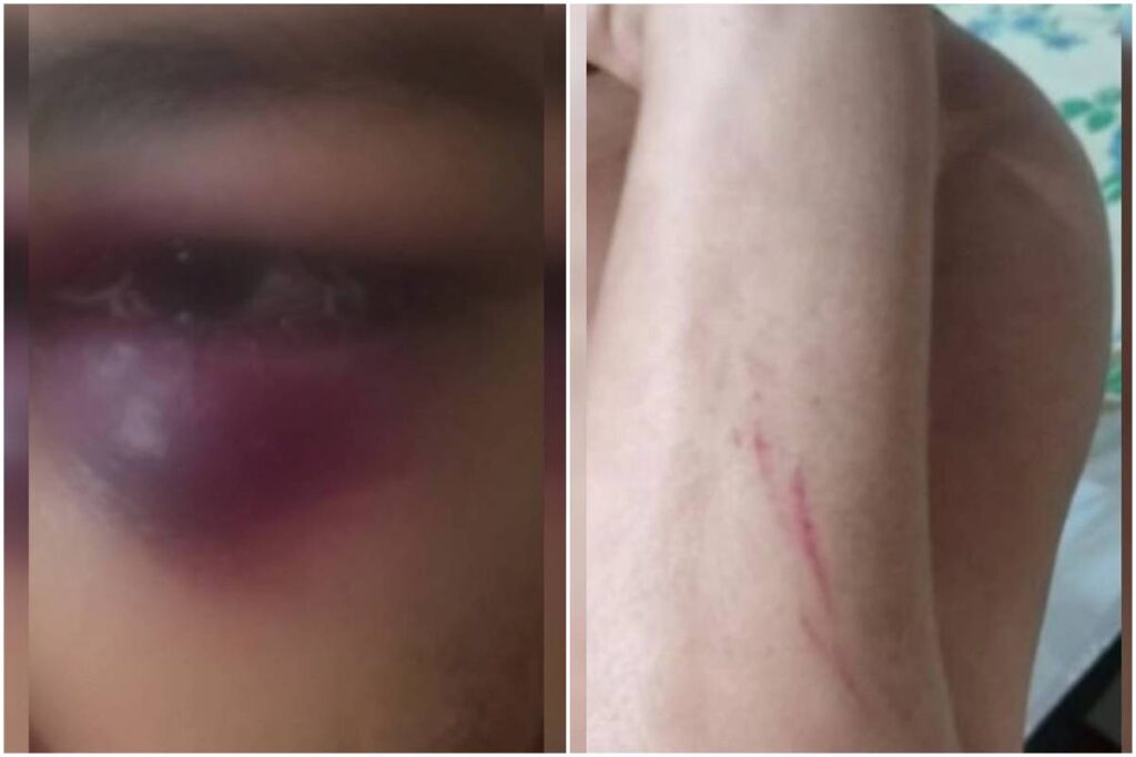 lesoes-e-olho-roxo:-mulher-e-agredida-pelo-marido-por-mais-de-12-horas