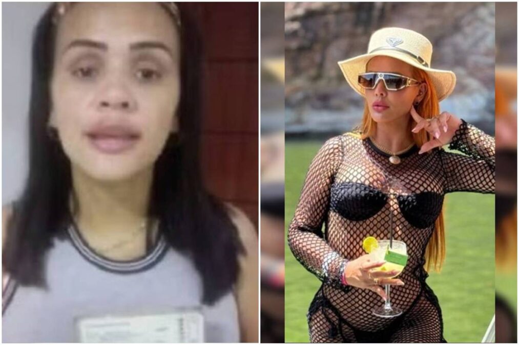 Mulher usa grana de golpe em cirurgias e “antes e depois” choca. Veja