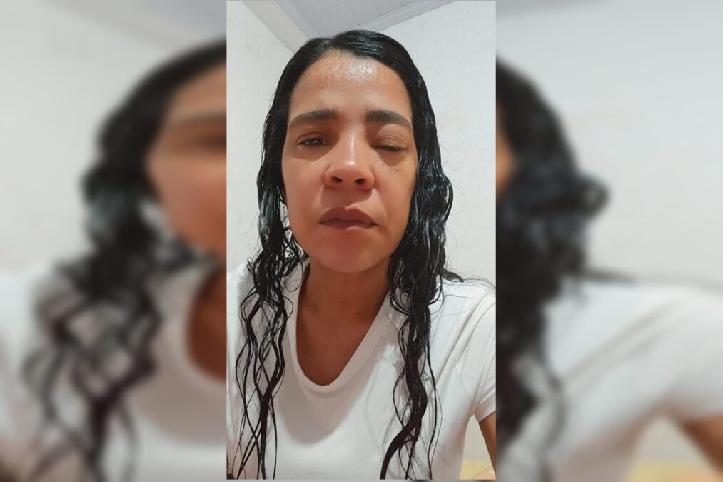 “Sou maltratada pela doença e pelo SUS”, diz mulher com câncer de pele