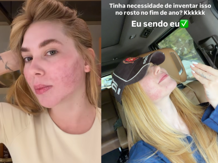 “tinha-necessidade?”,-virginia-brinca-apos-fazer-procedimento-que-deixa-a-pele-do-rosto-irritada