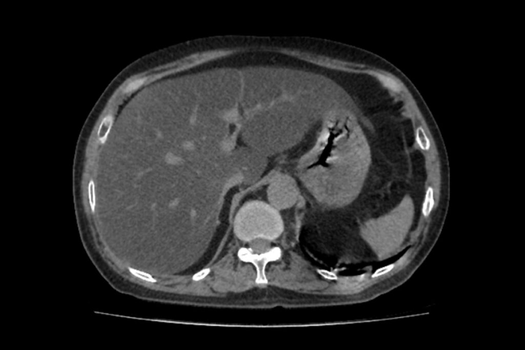 gordura-no-figado:-endocrinologista-diz-qual-e-o-melhor-tratamento