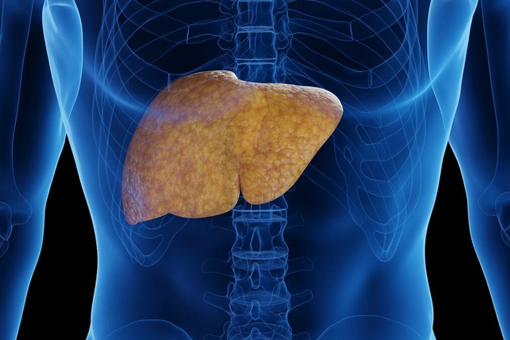 Hepatologistas contam os piores alimentos que causam gordura no fígado
