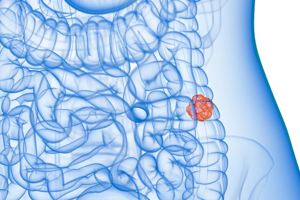 Coloproctologista lista os principais sintomas de câncer colorretal
