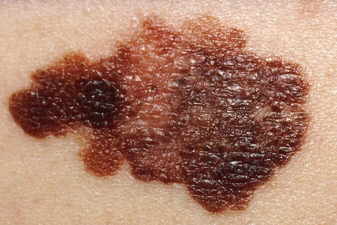 cancer-de-pele:-dermatologista-diz-como-identificar-sinais-suspeitos