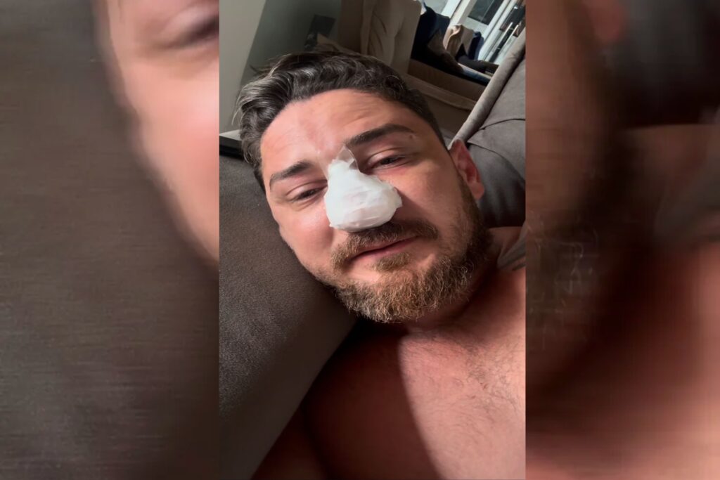 turista-agredido-em-porto-de-galinhas-corrige-4-fraturas-na-face