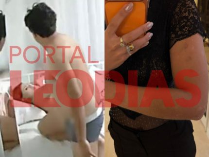 imagens-revelam-hematomas-de-esposa-agredida-por-cantor-paraibano