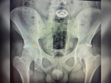 jovem-de-19-anos-e-internado-as-pressas-para-retirar-desodorante-preso-no-reto