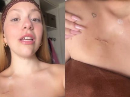 tratando-cancer,-neta-de-carlos-alberto-de-nobrega-mostra-cicatriz:-“marcas-do-processo”