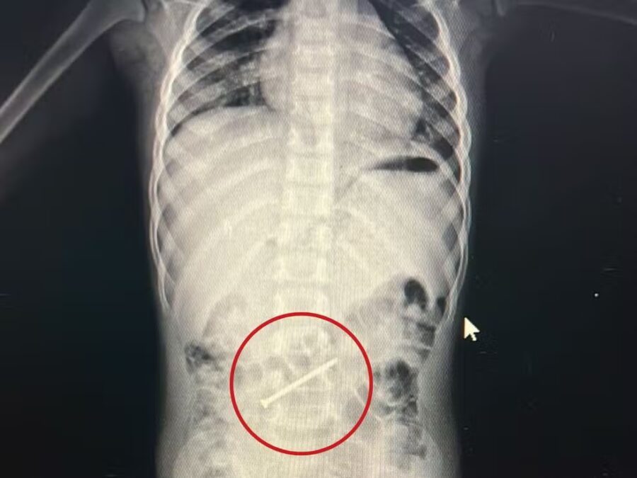 Médico retira prego do intestino de criança por colonoscopia no Juruá