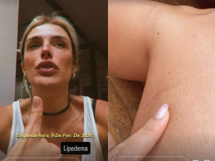 rafa-brites-revela-diagnostico-de-lipedema:-“vivo-com-roxos-que-eu-nao-sei-da-onde-e”