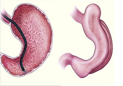 obesidade:-procedimento-sem-cortes-surge-como-alternativa-a-bariatrica-e-as-canetas-emagrecedoras