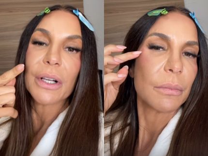 ivete-sangalo-atualiza-recuperacao-apos-cirurgia-no-rosto-e-anuncia-dias-de-folga