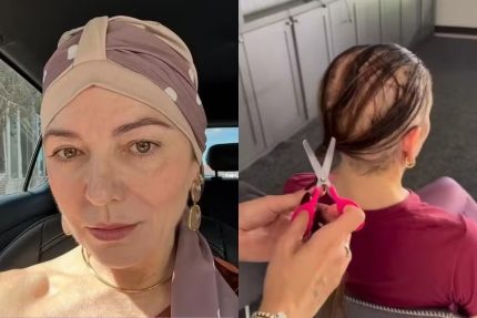 alopecia-areata:-especialista-explica-condicao-que-fez-mae-de-lucas-lucco-perder-cabelo