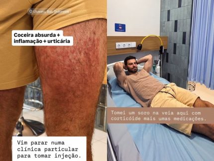 ex-ator-global-e-hospitalizado-na-indonesia-apos-sofrer-ataque-severo-de-acaros