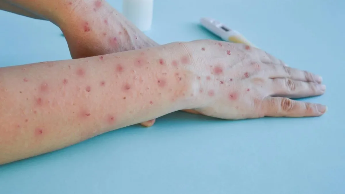 Casos de Mpox chegam a 140 no Brasil em 2026, sem registro de mortes, informa o Ministério da Saúde.