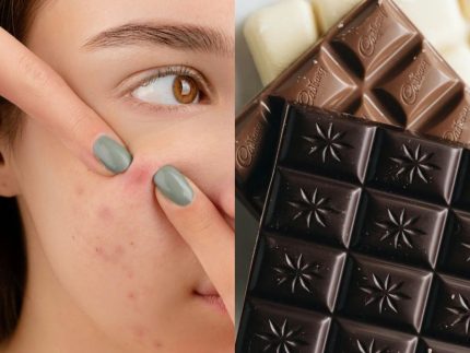 exagerou-no-chocolate-da-pascoa?-saiba-como-cuidar-da-pele-e-driblar-a-acne