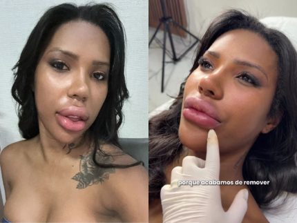 carol-lekker-assusta-seguidores-com-labios-inchados-e-revela-o-que-aconteceu