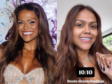 camila-loures-mostra-resultado-de-cirurgia-na-testa:-“so-quem-tem-sabe-o-quanto-incomoda”