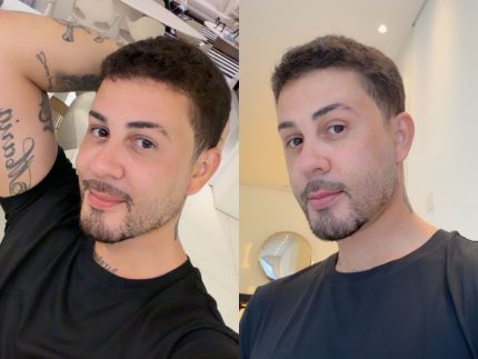 carlinhos-maia-reaparece-apos-sumico-das-redes-e-revela-resultado-de-cirurgia-estetica