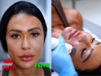 gracyanne-barbosa-reduz-intervencoes-no-rosto:-“nao-quero-mais-preenchimento”