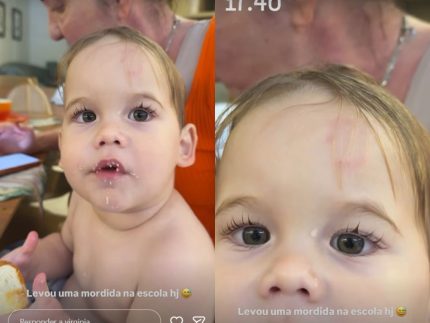 jose-leonardo,-filho-de-virginia,-e-mordido-na-escola-e-influenciadora-mostra-hematoma