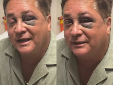 leonardo-aparece-com-olho-roxo-e-deixa-fas-em-choque;-entenda-o-motivo-do-hematoma