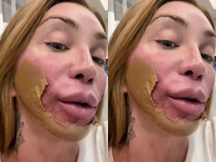 maya-massafera-passa-por-procedimento-estetico-que-“destroi-a-pele”;-entenda!