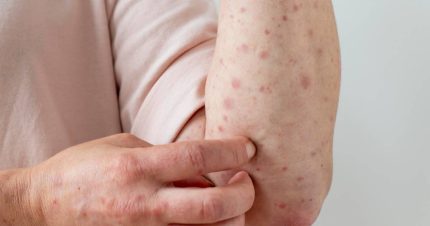 surto-de-sarampo-em-paises-da-copa-preocupa-autoridades-e-liga-alerta-no-brasil