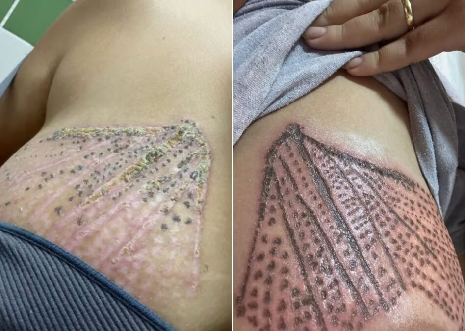 Mulher que sofreu queimaduras em procedimento estético denuncia descaso da polícia no Acre