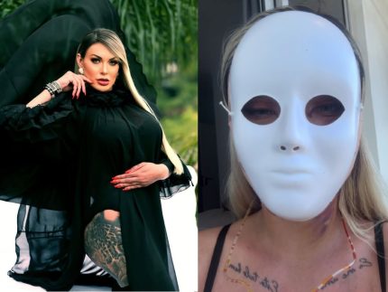 andressa-urach-mostra-novo-rosto-apos-50a-cirurgia-plastica:-“vou-ter-23-anos-novamente”