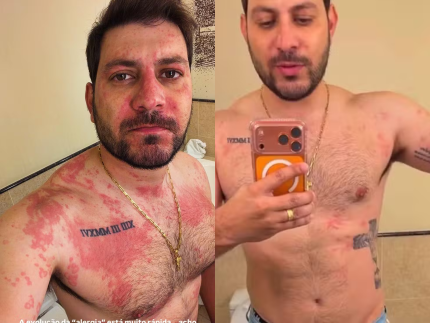 ex-bbb-caio-afiune-e-hospitalizado-apos-crise-alergica-e-relata-susto:-“muito-ofegante”