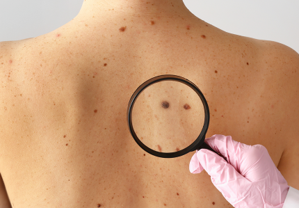 melanoma:-cancer-de-pele-mais-agressivo-pode-surgir-de-uma-pinta-“comum”;-especialista-alerta