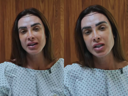 nicole-bahls-realiza-transplante-capilar-para-diminuir-a-testa:-“vou-ficar-feliz-e-cabeluda”